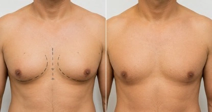 Gynecomastia treatment